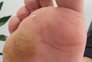 En fod med hård hud